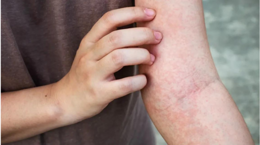 25 Common Reasons for Skin Allergy and Itching