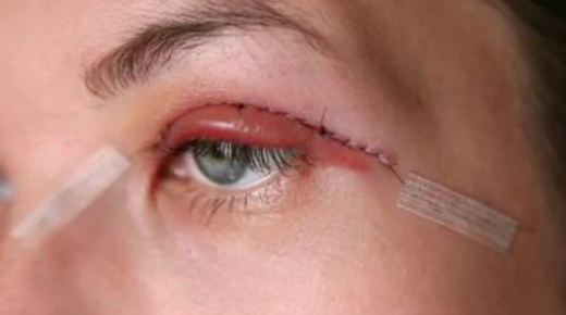 Day by Day Eyelid Surgery Recovery Time - What to Expect with Photos