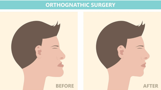 Orthognathic Surgery Before and After