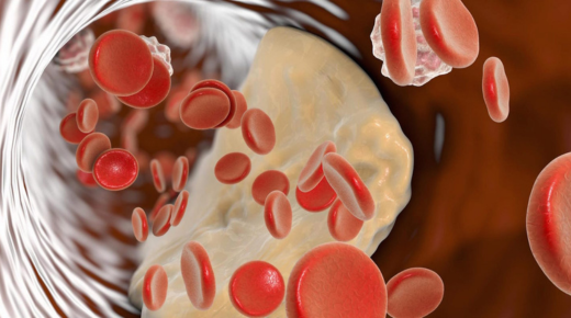 Understanding Angina Pectoris - Sorting Fact from Fiction