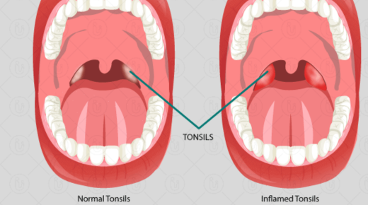 Understanding Inflamed Tonsils in English - A Comprehensive Guide