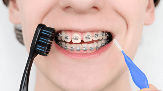 Dietary Tips for Maintaining Braces and Ensuring Success