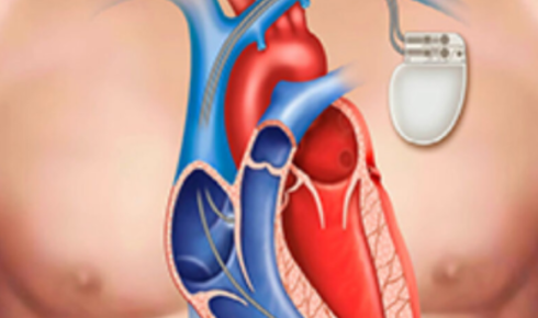 Pacemaker Surgery In Hyderabad